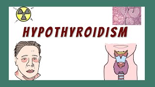 Hypothyroidism and Hashimotos Thyroiditis  Pathophysiology causes Diagnosis signs amp symptoms [upl. by Jerald]