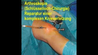 DozDrPabinger  Arthroskopie schwere Knieverletzung Knorpelschaden Mensicusriß Plicasyndrom [upl. by Lyrej]