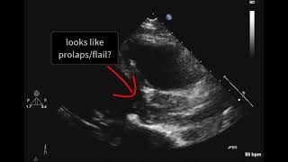 Destructed aortic valve [upl. by Nirrek]