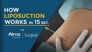 How Liposuction Works in 15 Seconds Medical Technology 3D Animation 2020 [upl. by Azal]