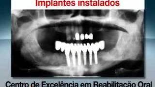 Implantes dentários com carga imediata [upl. by Nanoc65]