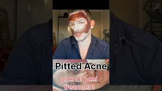 ACNE PHENOL PEEL USMLE NEET SHORTS [upl. by Aneryc1]