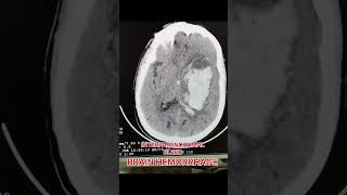 Brain Hemorrhage bleed radiology brain shortvideo [upl. by Bollay258]