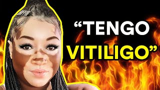 VIVIR CON VITILIGO Entrevista a Iomikoe Johnson [upl. by Lanoil]