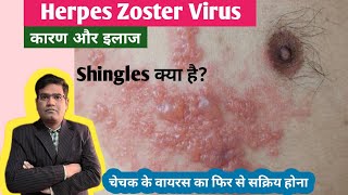 Herpes Zoster Shingles Disease Cause Symptoms and Treatment in Hindi  Varicella Zoster Virus [upl. by Esereht874]