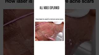 How lasers remove acne scars [upl. by Susan]