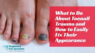 What to Do About Toenail Trauma and How to Easily Fix Their Appearance [upl. by Meraree]