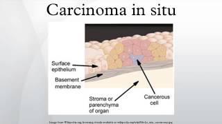 Carcinoma in situ [upl. by Ynneb]