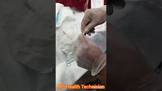 PCN Catheter how to Connected Percutaneous Nephrostomy Catheter with Urine bag without connector [upl. by Aicatsal]