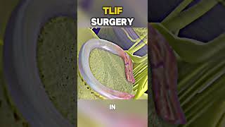 Struggling with Lower Back Pain Here’s How TLIF Surgery Can Help [upl. by Atived956]