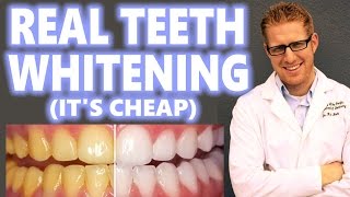 Teeth Whitening at Home Cheap How to Peroxide Hacks DIY Bleach Trays Kit Best 2016 Overnight Results [upl. by Nivlag96]