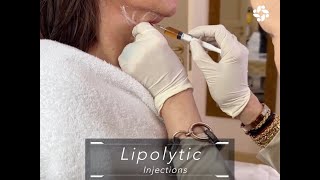 LIPOLYTIC INJECTIONS FOR FACIAL CONTOURING [upl. by Brewster640]