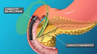CPRE COLANGIOPANCREATOGRAFÍA RETRÓGRADA ENDOSCÓPICA [upl. by Santini]