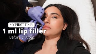 I GOT LIP FILLERS FOR THE FIRST TIME  1ML [upl. by Enahc]