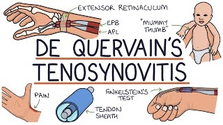 Understanding De Quervain’s Tenosynovitis Mummy Thumb [upl. by Jer108]