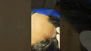 Steroid injection for Alopecia Areata [upl. by Drais]