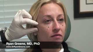 Juvederm VOLUMA Cheek amp Chin Augmentation in South Florida  Dr Ryan Greene [upl. by Anaiv321]