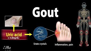 Gout Pathophysiology Causes Symptoms Risk Factors Diagnosis And Treatment Animation [upl. by Depoliti]