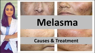 How to treat dark spots  Melasma  Causes amp treatment  Dermatologist  Dr Aanchal Panth [upl. by Ynnatirb]