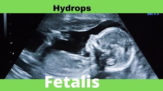 Hydrops Fetalis  Ultrasound  Anomaly  Case [upl. by Huskey]