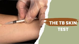 The TB Skin Test  Positive tb skin test [upl. by Boucher]