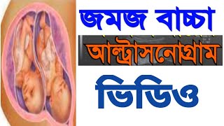 সারে চার মাসের জমজ বাচ্চার আল্টড়াসনোগ্রাম ভিডিও pregnancyultrasound pregnant pregnancy ultrasono [upl. by Yelrebmik990]