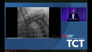 Complex Carotid Stent Procedure with Bovine Aortic Arch solved via a Transradial Approach [upl. by Yrollam]