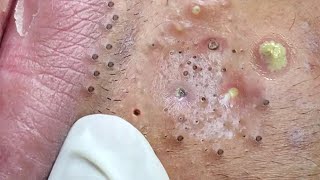 Big Cystic Acne Blackheads Extraction Blackheads amp Milia Whiteheads Removal Pimple Popping  3843 [upl. by Nanahs636]