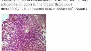 Adenocarcinoma Prognosis [upl. by Etnor]