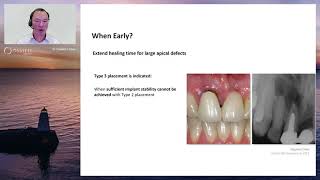 When Early Implant Placement [upl. by Flss]