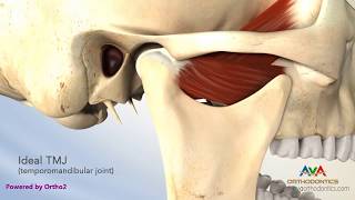 TMJ Disorder or TMD  Clicking and Closed Lock [upl. by Ahmad]