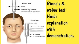 Rinne amp Weber test demonstration in Hindi explanation msn gnmcourse nursing ear [upl. by Verdha]