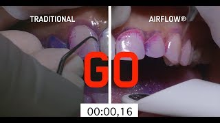 Abrasive teeth cleaning method vs AIRFLOW method [upl. by Aderfla]