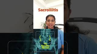 Sacroiliitis [upl. by Stiegler604]