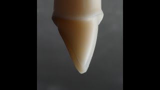 All Ceramic Crown Preparation for Emax and Zirconia [upl. by Nedrah]