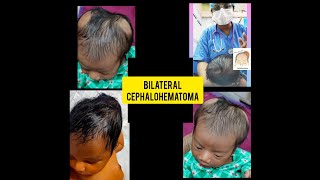 CephalohematomaCephalohematoma in newbornsBilateral cephalohematomaHead swelling in infant [upl. by Dukie]