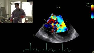 Live scan TOE severe aortic regurgitation bicuspid valve infective endocarditis [upl. by Canty]