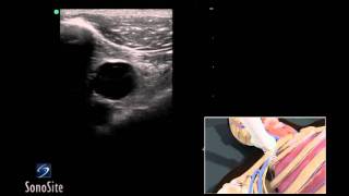 How To Ultrasound Guided Insertion of a Subclavian Vein Catheter 3D Video [upl. by Inatirb794]