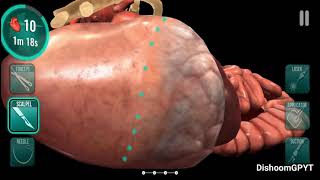 Operate Now Tonsil Surgery  walkthrough [upl. by Alleber795]