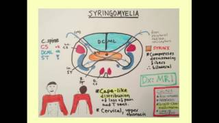 Syringomyelia  CRASH Medical Review Series [upl. by Etheline]