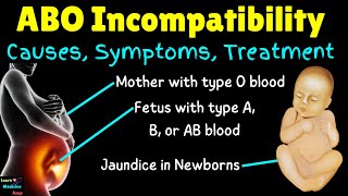 ABO Incompatibility in Newborns  ABO Incompatibility in Pregnancy – Causes Symptoms amp Treatments [upl. by Layor596]