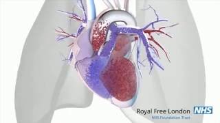 What is pulmonary hypertension [upl. by Arted]