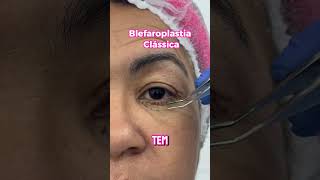 Explicando a Blefaroplastia clássica [upl. by Anikahs]