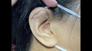 Treatment of auricular hematoma  othematoma  01 [upl. by Vizza]