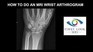 How to do an MRI wrist arthrogram [upl. by Trakas330]