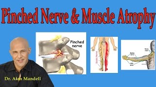 Pinched Nerve and Muscle Atrophy What You Should Understand  Dr Mandell [upl. by Juanne]