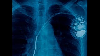 Automatic Implantable CardioverterDefibrillator AICD Explained CureU Healthcare cureuhealthcare [upl. by Neeven3]