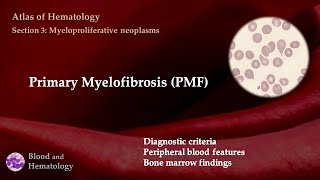 Primary Myelofibrosis PMF [upl. by Netsirk]