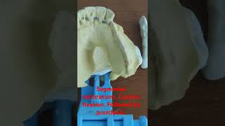 Segmental stabilization with castbar basalimplants implantdentist corticobasalimplants [upl. by Colan163]