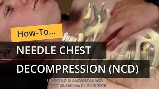 Needle Chest Decompression in TCCC [upl. by Ezri394]